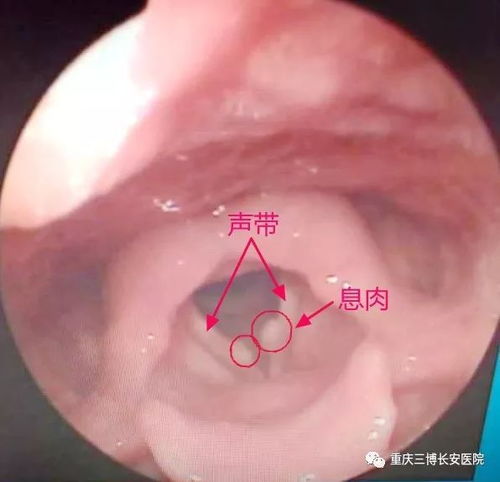 女性嗓子经常哑是怎么回事，女性声音嘶哑是什么疾病